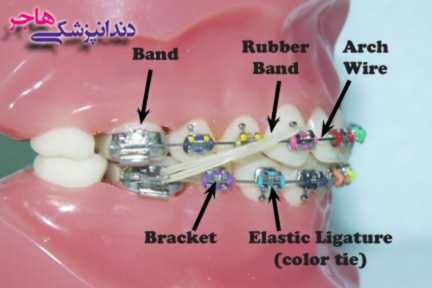 اجزای براکت دندان براکت دندان از اجزای مختلفی تشکیل شده است